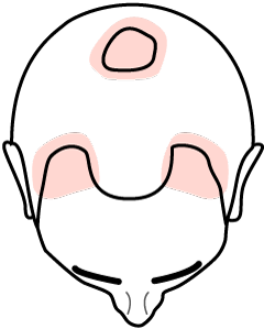 Bald Spots